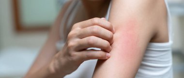 Cilt sorunu ve güzellik. Cilt alerjisi, steroid alerjisi, hassas cilt, güneş yanığı, kimyasal alerji, isilik, böcek ısırığı, Seborrheic Dermatiti...