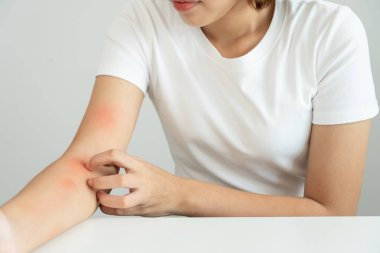 Cilt sorunu ve güzellik. Cilt alerjisi, steroid alerjisi, hassas cilt, güneş yanığı, kimyasal alerji, isilik, böcek ısırığı, Seborrheic Dermatitis..