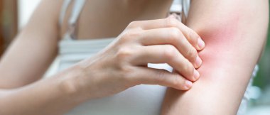 Cilt sorunu ve güzellik. Cilt alerjisi, steroid alerjisi, hassas cilt, güneş yanığı, kimyasal alerji, isilik, böcek ısırığı, Seborrheic Dermatitis..