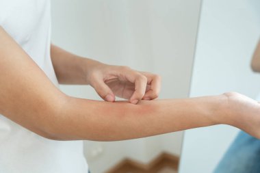 Cilt sorunu ve güzellik. Cilt alerjisi, steroid alerjisi, hassas cilt, güneş yanığı, kimyasal alerji, isilik, böcek ısırığı, Seborrheic Dermatitis.