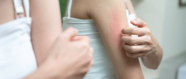 Cilt sorunu ve güzellik. Cilt alerjisi, steroid alerjisi, hassas cilt, güneş yanığı, kimyasal alerji, kızarıklık, böcek ısırıkları, Seborrheic Dermatitis..