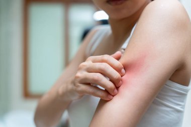 Cilt sorunu ve güzellik. Cilt alerjisi, steroid alerjisi, hassas cilt, güneş yanığı, kimyasal alerji, isilik, böcek ısırığı, Seborrheic Dermatitis..