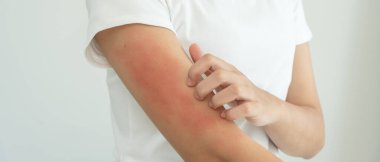 Cilt sorunu ve güzellik. Cilt alerjisi, steroid alerjisi, hassas cilt, güneş yanığı, kimyasal alerji, isilik, böcek ısırığı, Seborrheic Dermatitis..