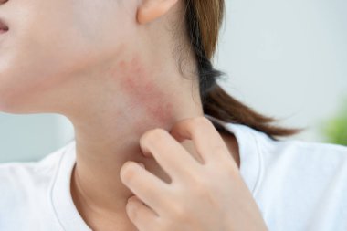 Cilt sorunu ve güzellik. Cilt alerjisi, steroid alerjisi, hassas cilt, güneş yanığı, kimyasal alerji, isilik, böcek ısırığı, Seborrheic Dermatitis.