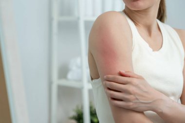 Cilt sorunu ve güzellik. Cilt alerjisi, steroid alerjisi, hassas cilt, güneş yanığı, kimyasal alerji, kızarıklık, böcek ısırıkları, Seborrheic Dermatitis..