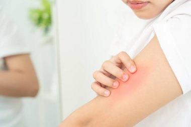 Cilt sorunu ve güzellik. Cilt alerjisi, steroid alerjisi, hassas cilt, güneş yanığı, kimyasal alerji, kızarıklık, böcek ısırıkları, Seborrheic Dermatitis..