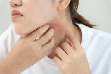 Cilt sorunu ve güzellik. Cilt alerjisi, steroid alerjisi, hassas cilt, güneş yanığı, kimyasal alerji, kızarıklık, böcek ısırıkları, Seborrheic Dermatitis..
