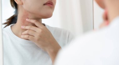 Cilt sorunu ve güzellik. Cilt alerjisi, steroid alerjisi, hassas cilt, güneş yanığı, kimyasal alerji, kızarıklık, böcek ısırıkları, Seborrheic Dermatitis..