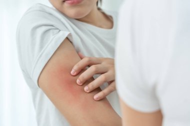 Cilt sorunu ve güzellik. Cilt alerjisi, steroid alerjisi, hassas cilt, güneş yanığı, kimyasal alerji, isilik, böcek ısırığı, Seborrheic Dermatitis..