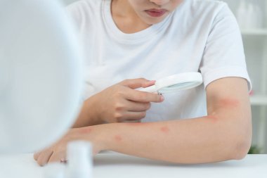 Cilt sorunu ve güzellik. Asyalı kadın deri alerjisi, şok, steroid alerjisi, hassas, kimyasal alerji, kızarıklık, böcek ısırıkları, Seborrheic Dermatitis yüzünden kaşındırıcı cam kullanıyor..