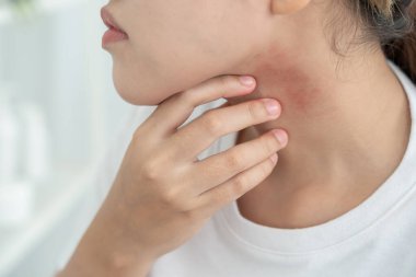 Cilt sorunu ve güzellik. Cilt alerjisi, steroid alerjisi, hassas cilt, güneş yanığı, kimyasal alerji, kızarıklık, böcek ısırıkları, Seborrheic Dermatitis..