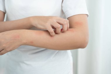 Cilt sorunu ve güzellik. Cilt alerjisi, steroid alerjisi, hassas cilt, güneş yanığı, kimyasal alerji, kızarıklık, böcek ısırıkları, Seborrheic Dermatitis..