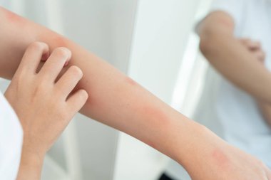 Cilt sorunu ve güzellik. Cilt alerjisi, steroid alerjisi, hassas cilt, güneş yanığı, kimyasal alerji, isilik, böcek ısırığı, Seborrheic Dermatitis..