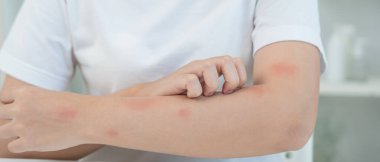 Cilt sorunu ve güzellik. Cilt alerjisi, steroid alerjisi, hassas cilt, güneş yanığı, kimyasal alerji, isilik, böcek ısırığı, Seborrheic Dermatitis.