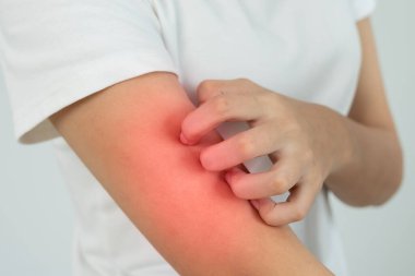 Cilt sorunu ve güzellik. Cilt alerjisi, steroid alerjisi, hassas cilt, güneş yanığı, kimyasal alerji, isilik, böcek ısırığı, Seborrheic Dermatitis..