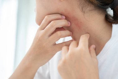 Cilt sorunu ve güzellik. Cilt alerjisi, steroid alerjisi, hassas cilt, güneş yanığı, kimyasal alerji, isilik, böcek ısırığı, Seborrheic Dermatitis.