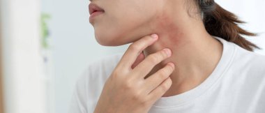 Cilt ve güzellik sorunları Kadınların kaşındıran derileri ve kozmetik alerjileri, steroid alerjileri, hassas ciltleri, güneş ışığı kızarıklıkları, kimyasal alerjileri, isilikleri, böcek ısırıkları yüzünden kızarıklıkları var..