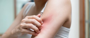 Cilt sorunu ve güzellik. Cilt alerjisi, steroid alerjisi, hassas cilt, güneş yanığı, kimyasal alerji, isilik, böcek ısırığı, Seborrheic Dermatitis..