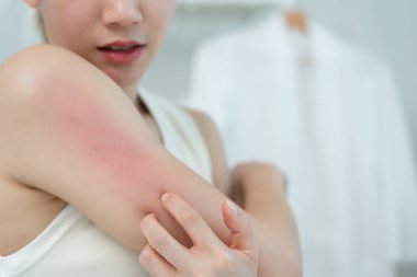 Cilt sorunu ve güzellik. Cilt alerjisi, steroid alerjisi, hassas cilt, güneş yanığı, kimyasal alerji, kızarıklık, böcek ısırıkları, Seborrheic Dermatitis.