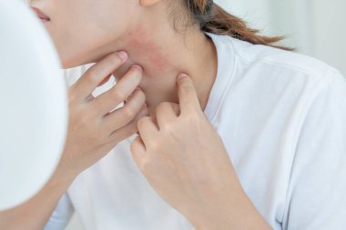 Cilt sorunu ve güzellik. Cilt alerjisi, steroid alerjisi, hassas cilt, güneş yanığı, kimyasal alerji, isilik, böcek ısırığı, Seborrheic Dermatitis.