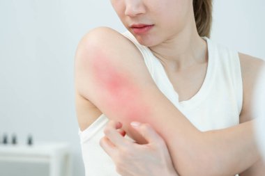 Cilt sorunu ve güzellik. Cilt alerjisi, steroid alerjisi, hassas cilt, güneş yanığı, kimyasal alerji, isilik, böcek ısırığı, Seborrheic Dermatitis..