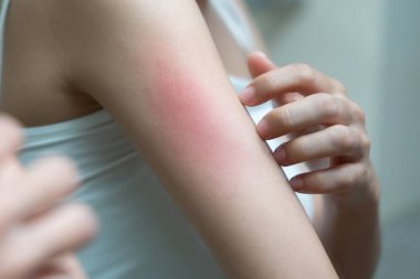 Cilt sorunu ve güzellik. Cilt alerjisi, steroid alerjisi, hassas cilt, güneş yanığı, kimyasal alerji, isilik, böcek ısırığı, Seborrheic Dermatitis..