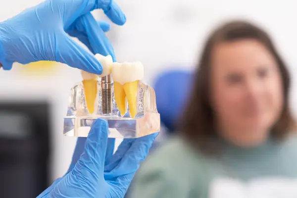 Modern klinikte diş implantı modeli: diş implantasyonu ve kaplama, sağlıklı diş tedavileri. 