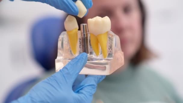 歯科インプラント 歯科医が患者との治療計画を議論する歯科インプラントモデルを保持し 現代の歯科クリニックでの患者教育の重要性を強調 — ストック動画