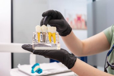 Diş uzmanı, diş implantı tacını gösteriyor ve diş implantı bakımı ve sağlıklı diş bakımı konusunda tavsiye veriyor.. 