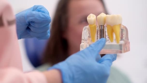 Model Implantu Stomatologicznego Nowoczesnej Klinice Implantacja Korona Zębów Zdrowe Leczenie — Wideo stockowe