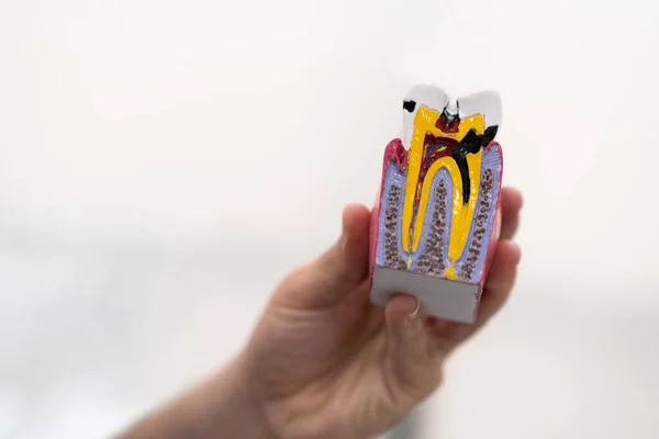 Dentiste Main Tenant Modèle Plastique Dent Humaine Frappée Caries Sur — Photo