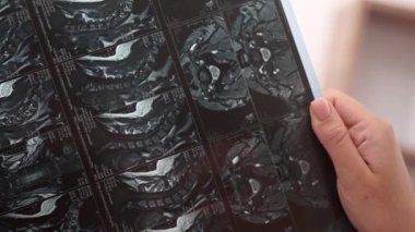 Doktor elleri, hastanın röntgen filmlerini ve MR taramalarını Vertebral Kol ile inceliyor.