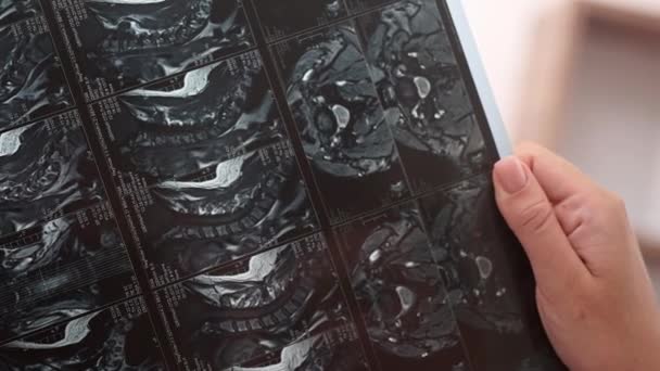患者のX線フィルムとMriスキャンを検査する医師の手を閉じる バーテブラルコラム — ストック動画