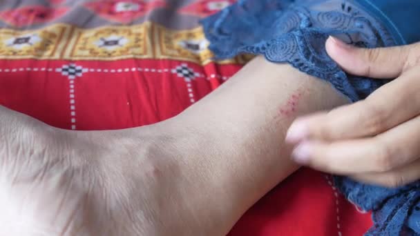 Νέες Γυναίκες Που Πάσχουν Από Κνησμό Του Δέρματος Πόδια Της — Αρχείο Βίντεο