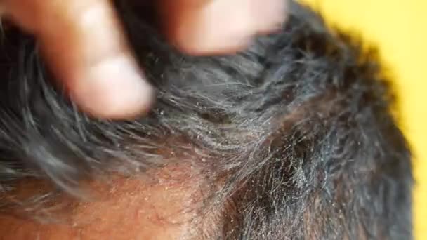 Мужчины Перхоти Волосах Крупным Планом — стоковое видео