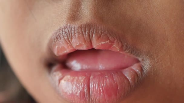 Close Baby Dry Lip — Stock Video