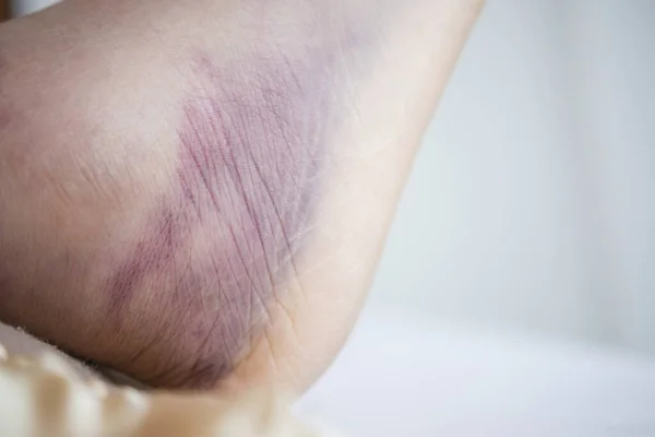 Close Women Feet Swelling — Stock Photo, Image