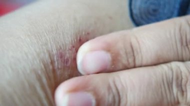 young women suffering from itching skin .
