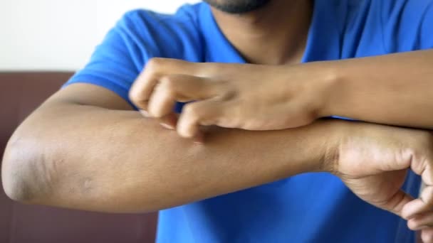 Man Suffering Itching Skin Close — Stock Video