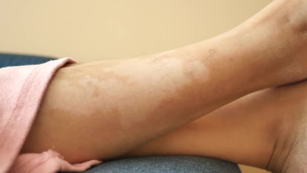 Nohy Vitiligem Kožní Onemocnění — Stock video