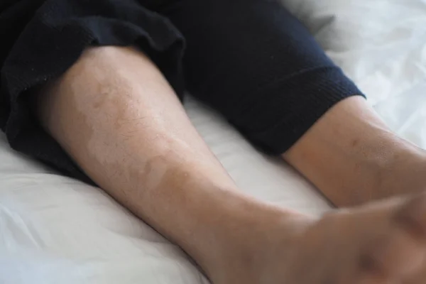 Feet Vitiligo Skin Condition — Stock Photo, Image