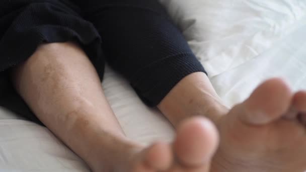 Feet Vitiligo Skin Condition — Stock Video