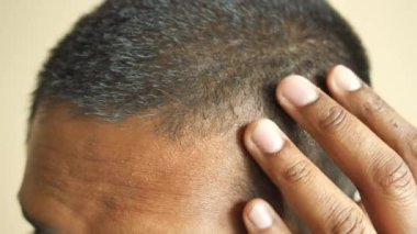 Saç dökülmesi konsepti. .