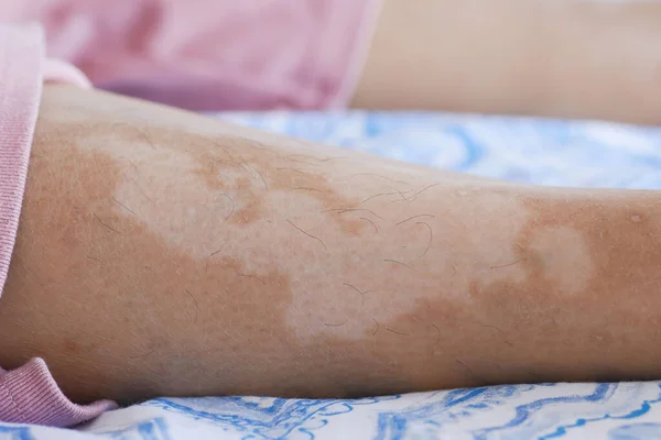 Feet Vitiligo Skin Condition — Stock Photo, Image