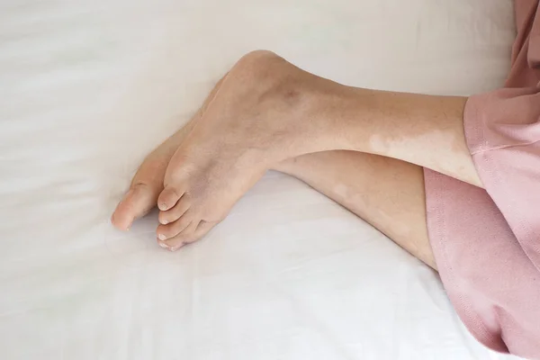 Πόδια Λεύκη Κατάσταση Του Δέρματος — Φωτογραφία Αρχείου