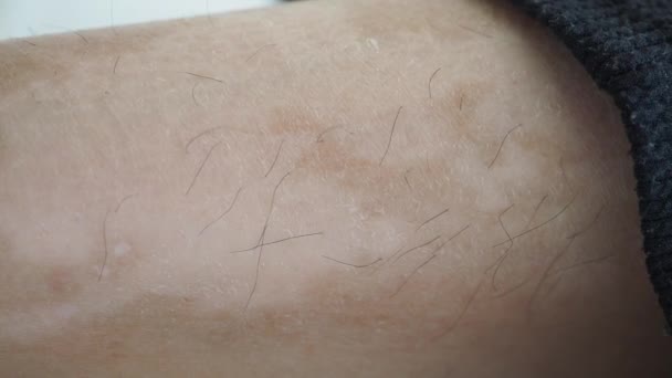 Pés Com Condição Pele Vitiligo — Vídeo de Stock
