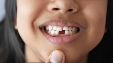 Dişleri eksik çocuğun detaylı görüntüsü..