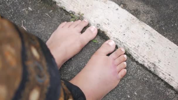 Närbild Kvinnors Fötter Med Svullnad — Stockvideo