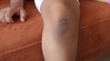  Dizinde kaşıntı olan bir çocuk. .