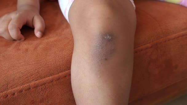 Child Girl Suffering Itching Skin Knee — Stock Video